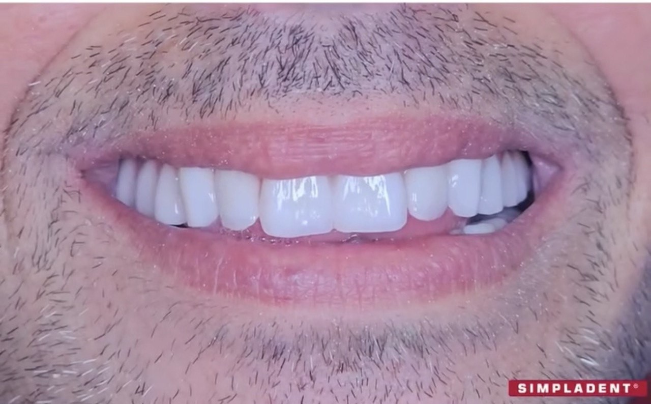 Strategic Implant® до