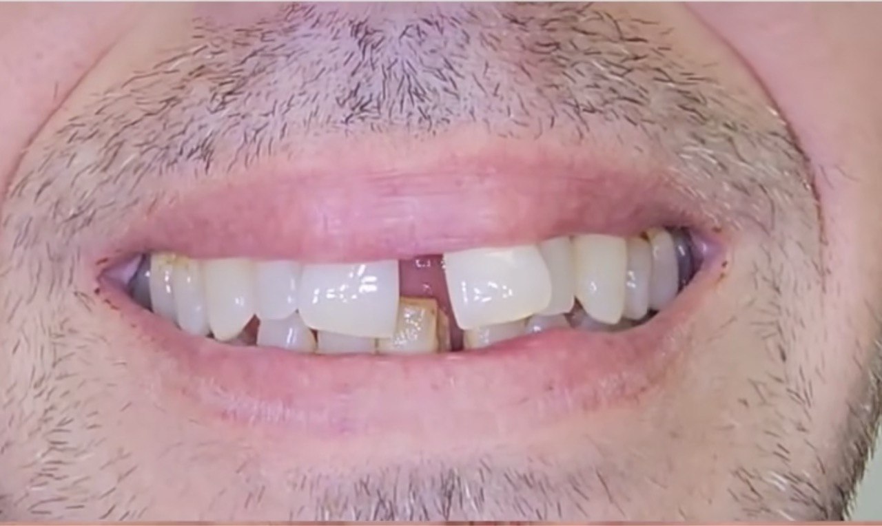 Strategic Implant® після